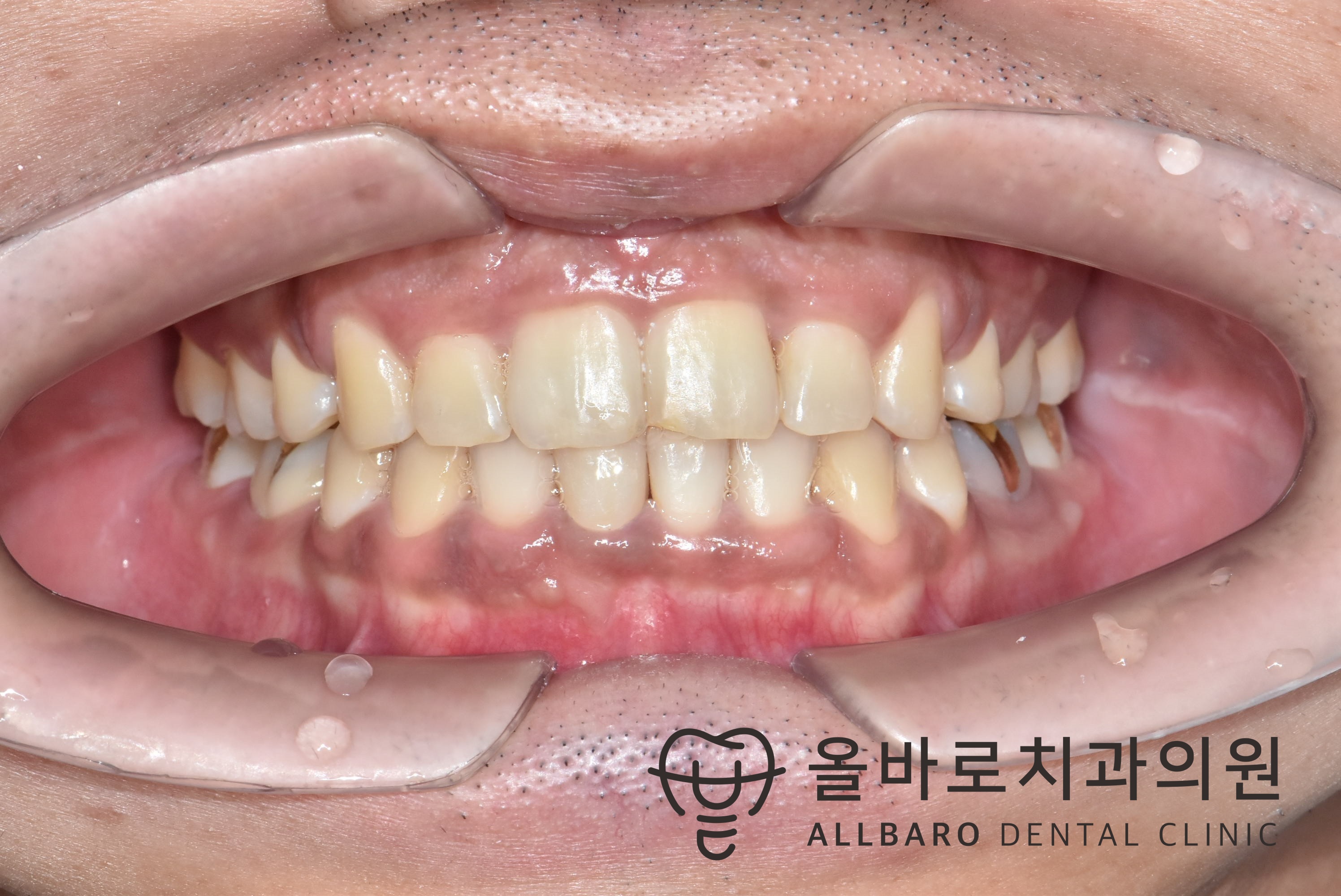 돌출입과 비뚤어진 앞니의 교정 기록 치료 후·중