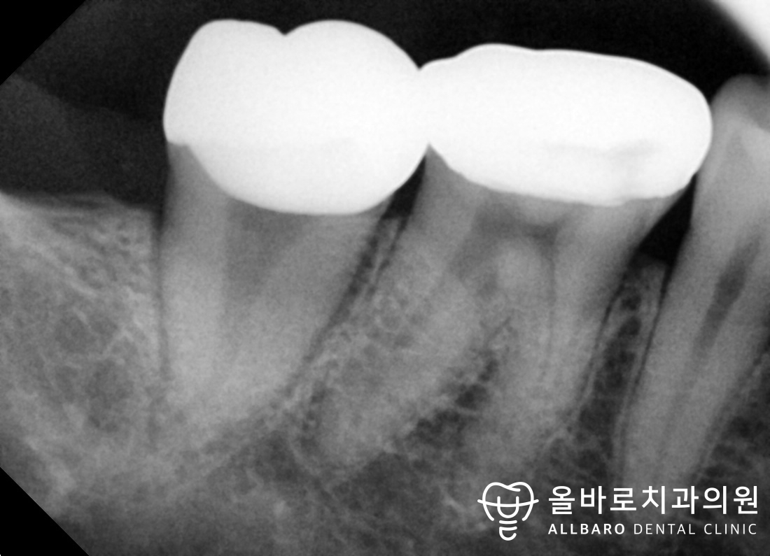 씹을 때 아픈 어금니와 크랙을 살핀 기록 치료 후·중