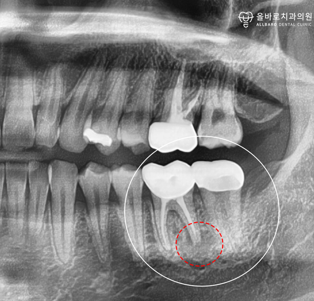 올바로치과 치료 기록 이미지