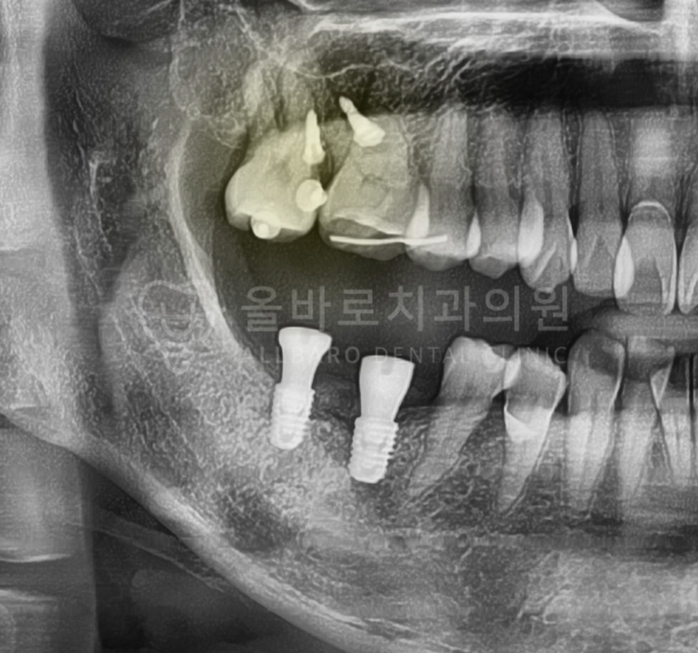 올바로치과 치료 기록 이미지
