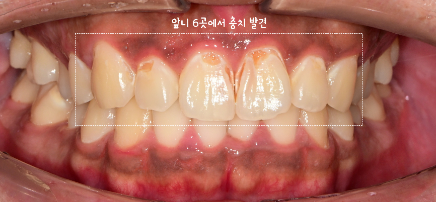 올바로치과 치료 기록 이미지
